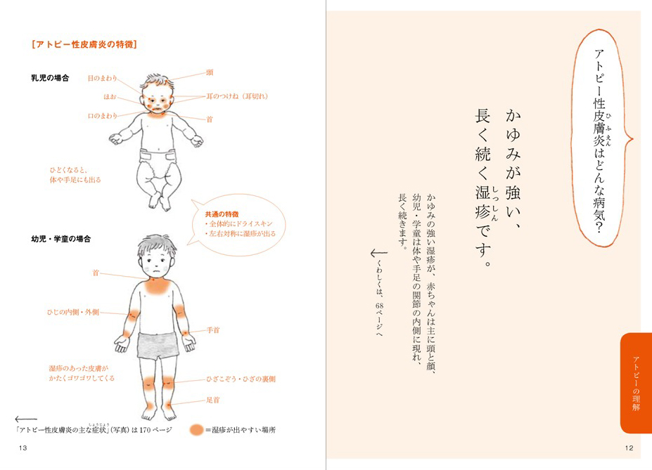 正しく知ろう　子どものアトピー性皮膚炎